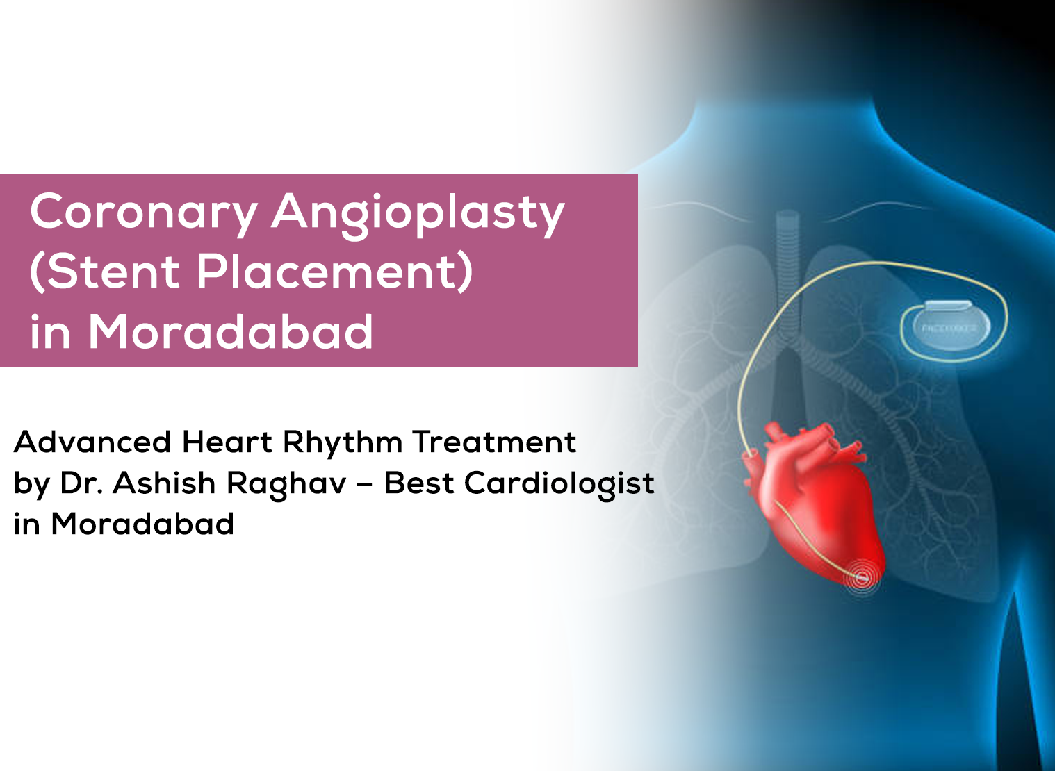 Coronary Angiography in Moradabad